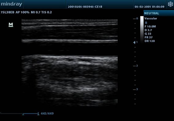 Mindray M9T портативный аппарат УЗИ