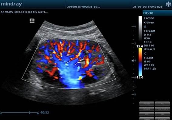 УЗИ аппарат Mindray M5 портативный