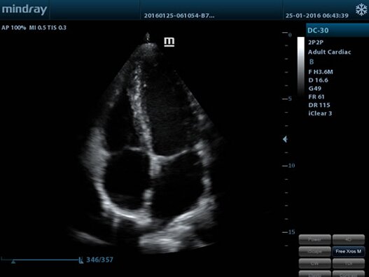 УЗИ аппарат Mindray M5 портативный