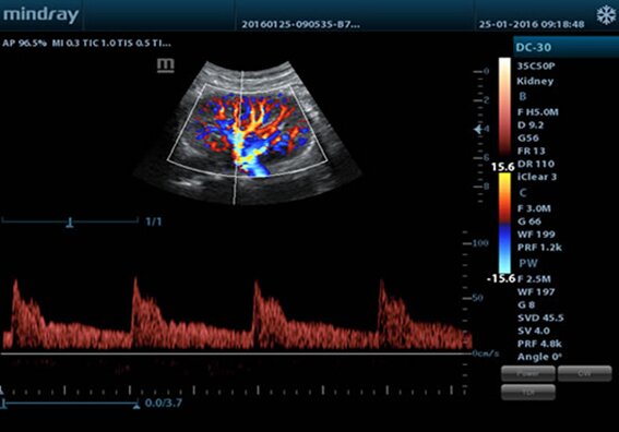 УЗИ аппарат Mindray M5 портативный