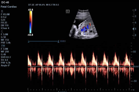УЗИ аппарат Mindray DC-45