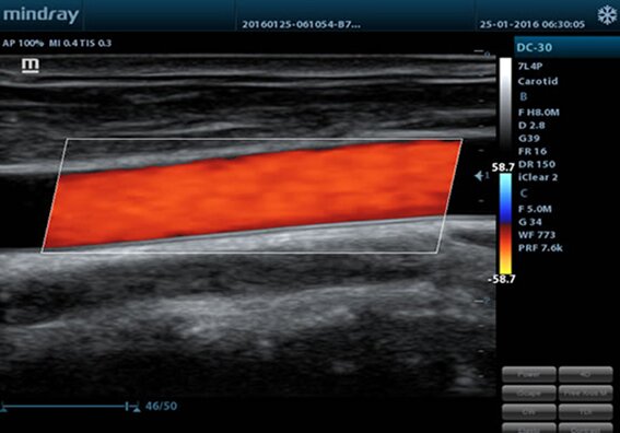УЗИ аппарат Mindray M5 портативный