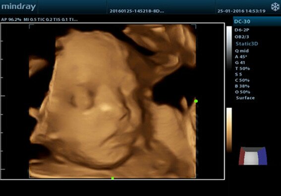 Mindray DC-30 аппарат УЗИ