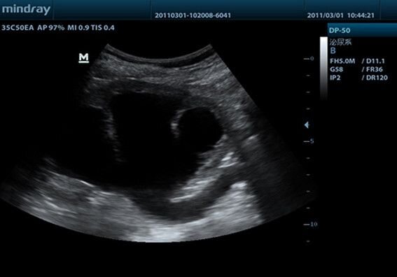 Mindray DP-50 УЗИ аппарат портативный