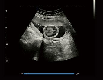 Chison XBit 90 ультразвуковой аппарат