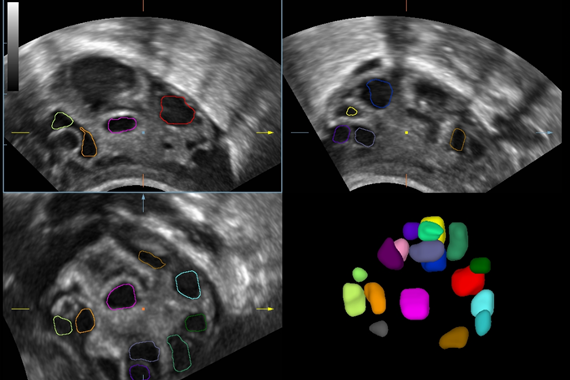 УЗИ аппарат Mindray DC-45