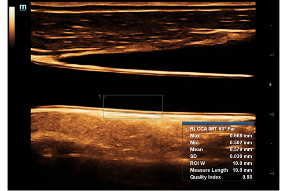 УЗИ аппарат Mindray DC-45