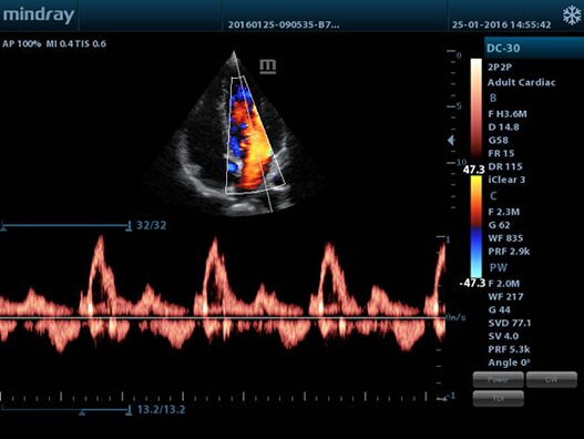 УЗИ аппарат Mindray M5 портативный