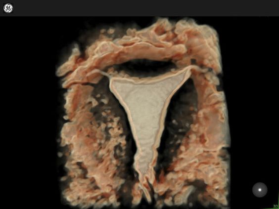 GE Voluson Expert 22 аппарат УЗИ