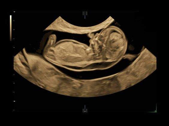 GE Voluson E10 аппарат УЗИ