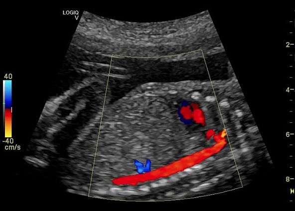GE Logiq V5 аппарат ультразвуковой