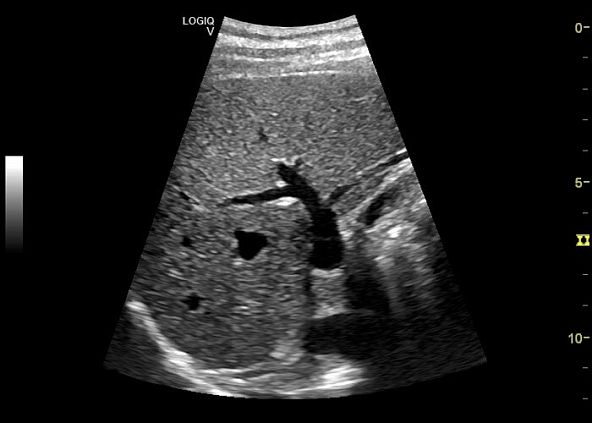 GE Logiq V5 аппарат ультразвуковой