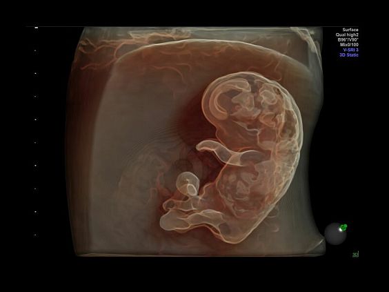 GE Voluson E10 аппарат УЗИ