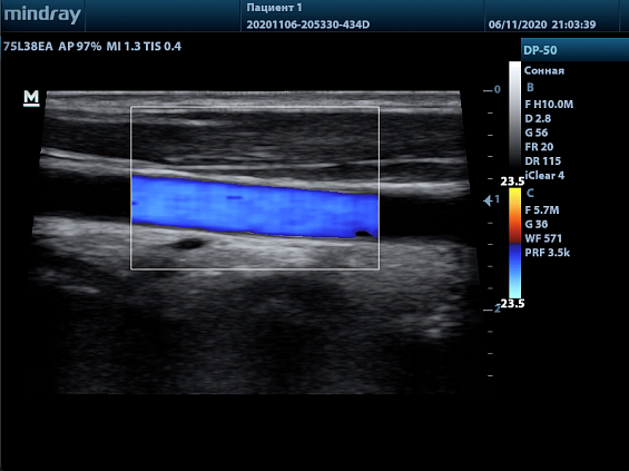 Mindray DP-50 Color аппарат УЗИ