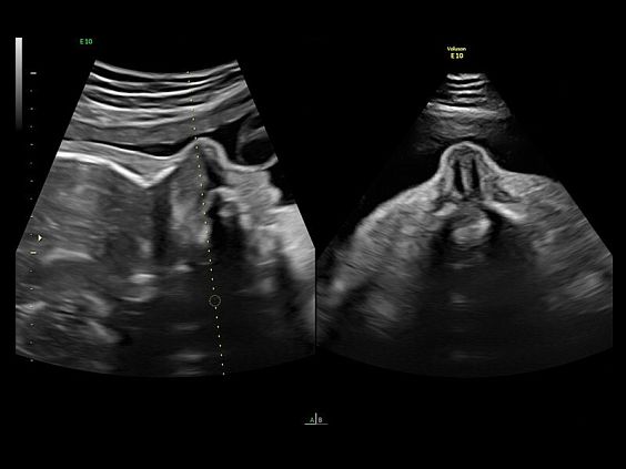 GE Voluson E10 аппарат УЗИ