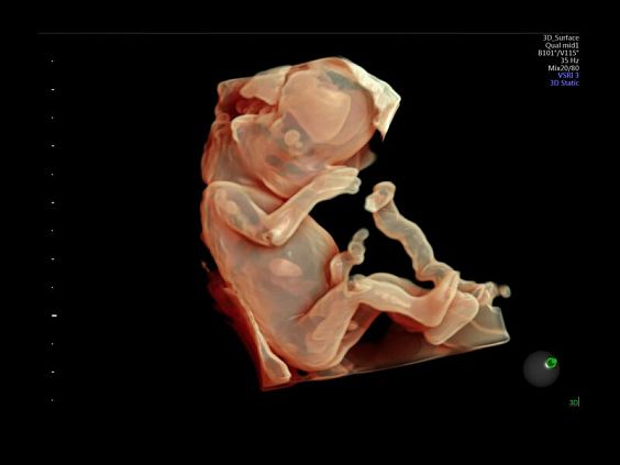 GE Voluson E10 аппарат УЗИ