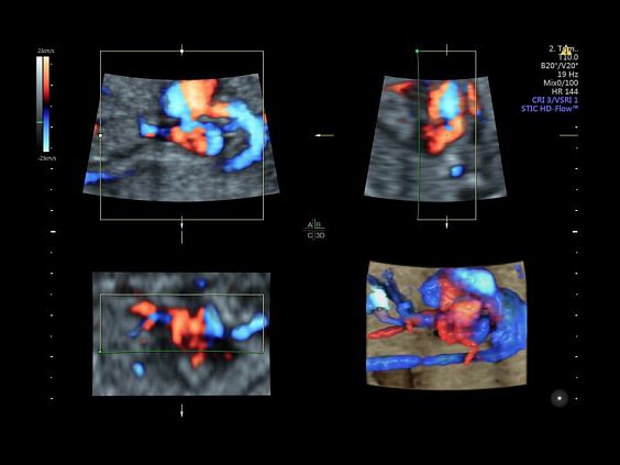 GE Voluson E10 аппарат УЗИ