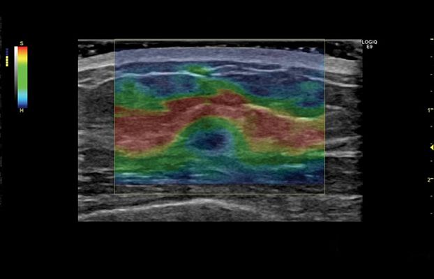 GE Logiq S8 XDclear ультразвуковая диагностическая система