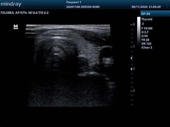 Mindray DP-50 Color аппарат УЗИ