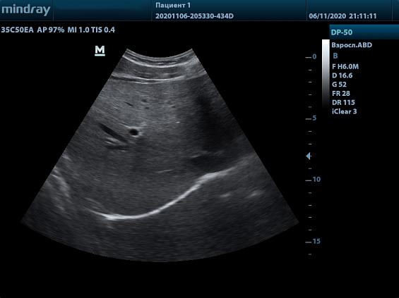 Mindray DP-50 Color аппарат УЗИ