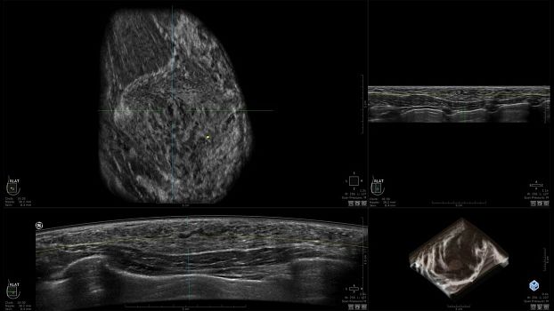 GE Invenia ABUS ультразвуковая система