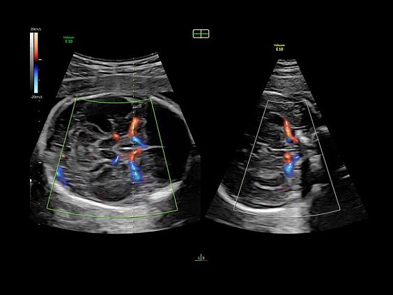 GE Voluson E10 аппарат УЗИ