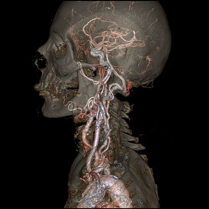 Компьютерный томограф GE Revolution CT 256 (512)