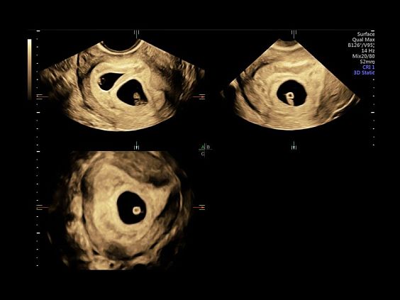 GE Voluson E10 аппарат УЗИ