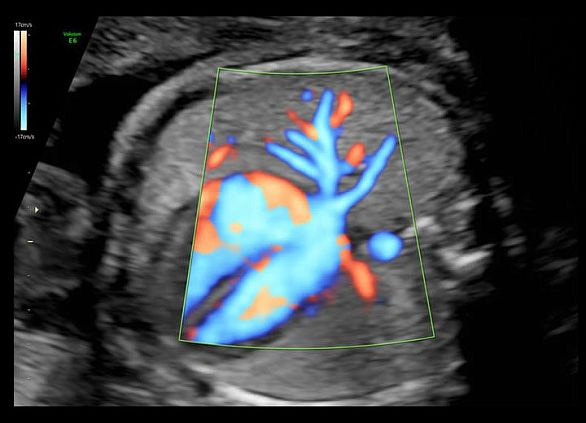 GE Voluson E6 аппарат УЗИ