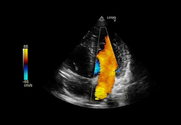GE Logiq V2 УЗИ аппарат портативный