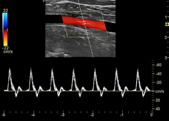 GE Logiq V5 аппарат ультразвуковой