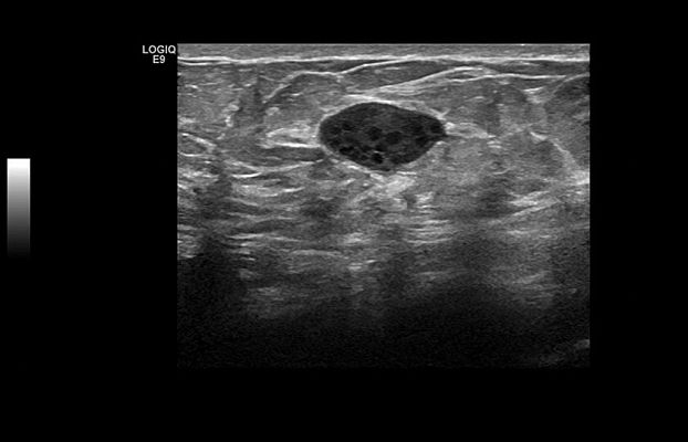 GE Logiq S8 XDclear ультразвуковая диагностическая система
