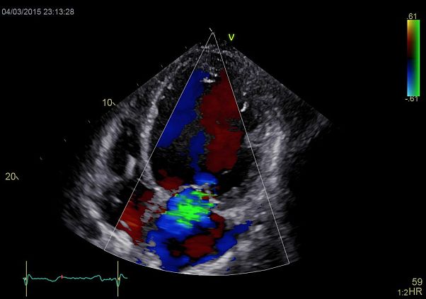 GE Vivid E90 аппарат УЗИ