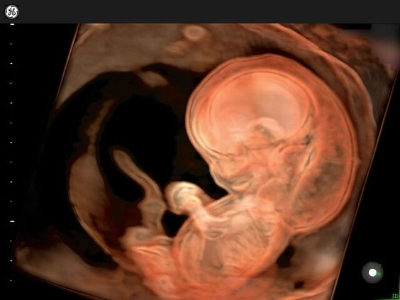 GE Voluson Expert 22 аппарат УЗИ