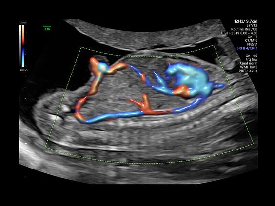 GE Voluson E10 аппарат УЗИ