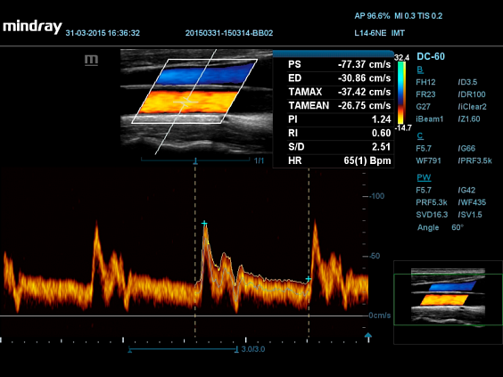 УЗИ аппарат Mindray DC-55