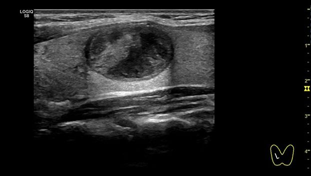 GE Logiq S8 XDclear ультразвуковая диагностическая система