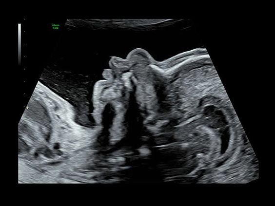 GE Voluson E10 аппарат УЗИ