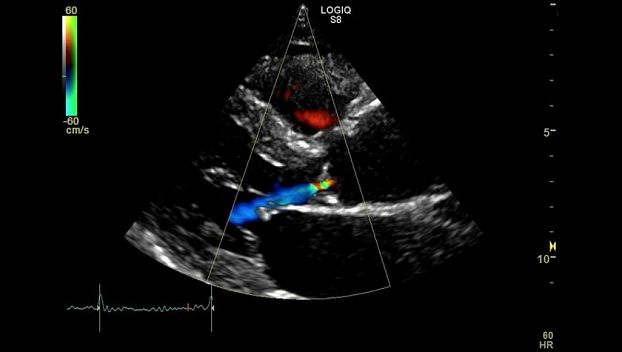 GE Logiq S8 XDclear ультразвуковая диагностическая система