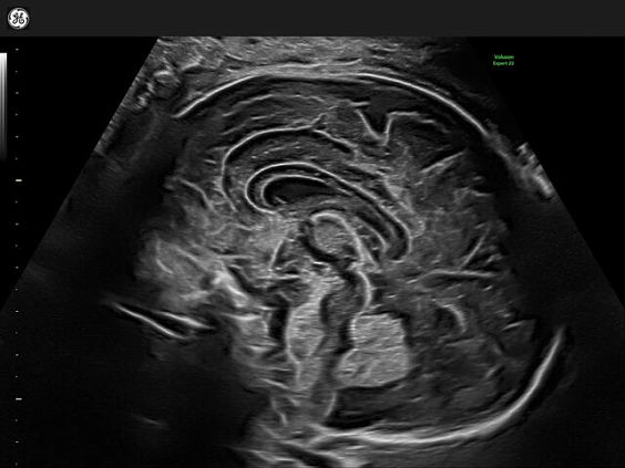 GE Voluson Expert 22 аппарат УЗИ