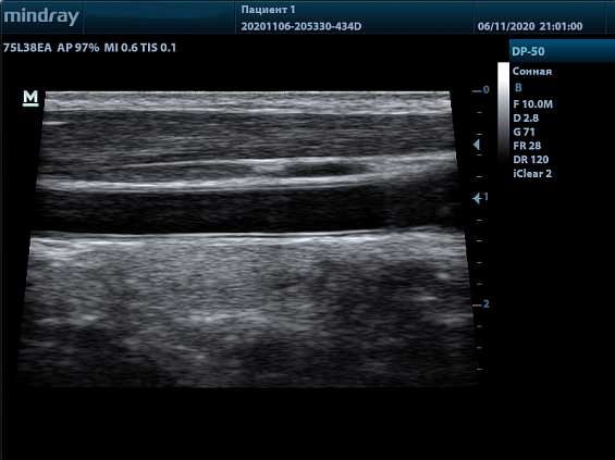 Mindray DP-50 Color аппарат УЗИ