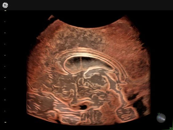 GE Voluson Expert 22 аппарат УЗИ