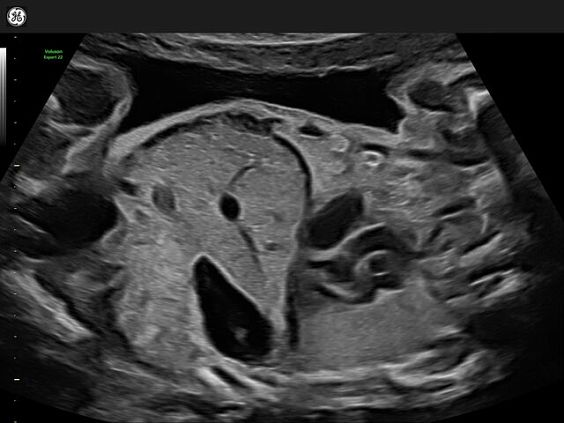 GE Voluson Expert 22 аппарат УЗИ