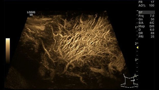 GE Logiq S8 XDclear ультразвуковая диагностическая система