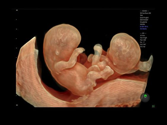 GE Voluson E10 аппарат УЗИ