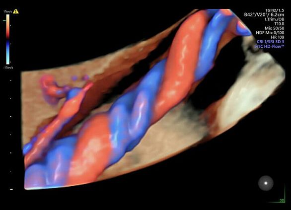 GE Voluson E6 аппарат УЗИ