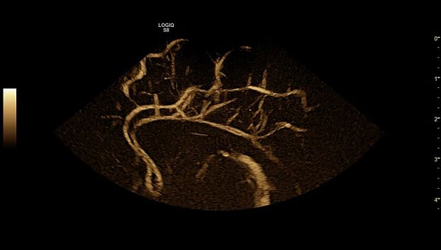GE Logiq S8 XDclear ультразвуковая диагностическая система