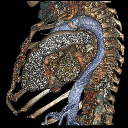 Компьютерный томограф GE Revolution CT 256 (512)