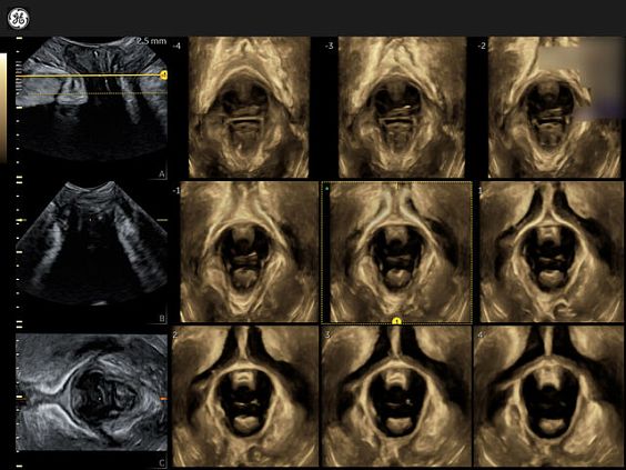 GE Voluson Expert 22 аппарат УЗИ