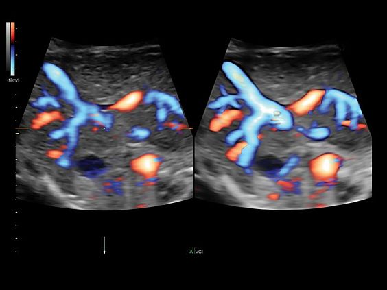 GE Voluson E10 аппарат УЗИ